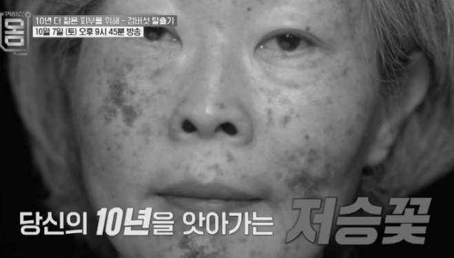 귀하신몸 검버섯 치료 방법과 병원 연락처